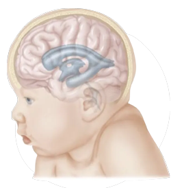vector image of baby having fluid in the brain