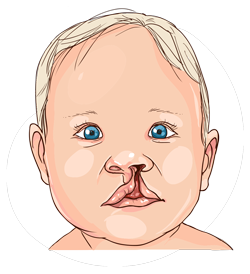 vector image of cleft palate