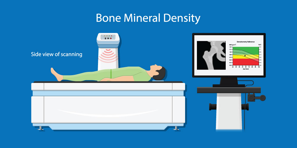 A vector illustration of DEXA scans for Bone mineral density.